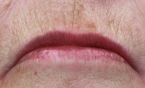 Softening of vertical lip lines