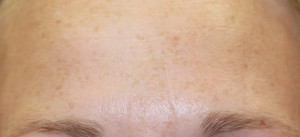 forhead frowning after treatment