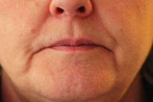 Softening of Nose to mouth lines before