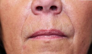 softening of nose to mouth lines using dermal filler after