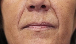 softening of nose to mouth lines using dermal filler before